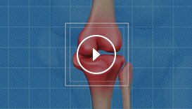 Overview of Knee Replacements